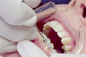 Ортодонтическое лечение зубов - фото