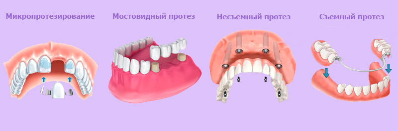 Фото видов протезирования зубов в Подольске